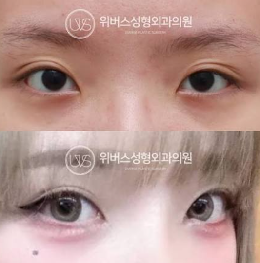 Eye surgery