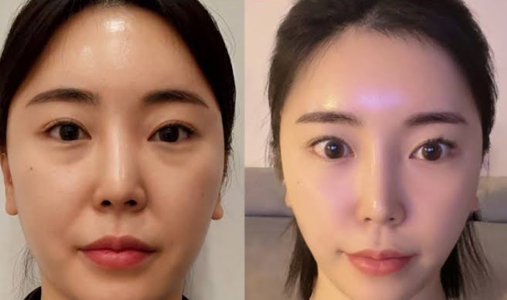 Anti-ageing and lifting