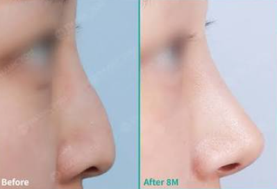 Rhinoplasty